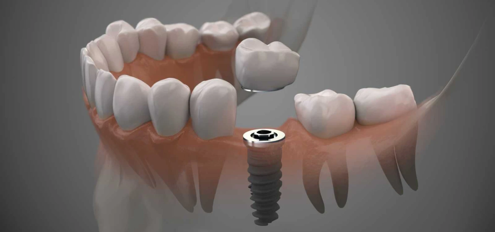 Pose d'implant dentaire