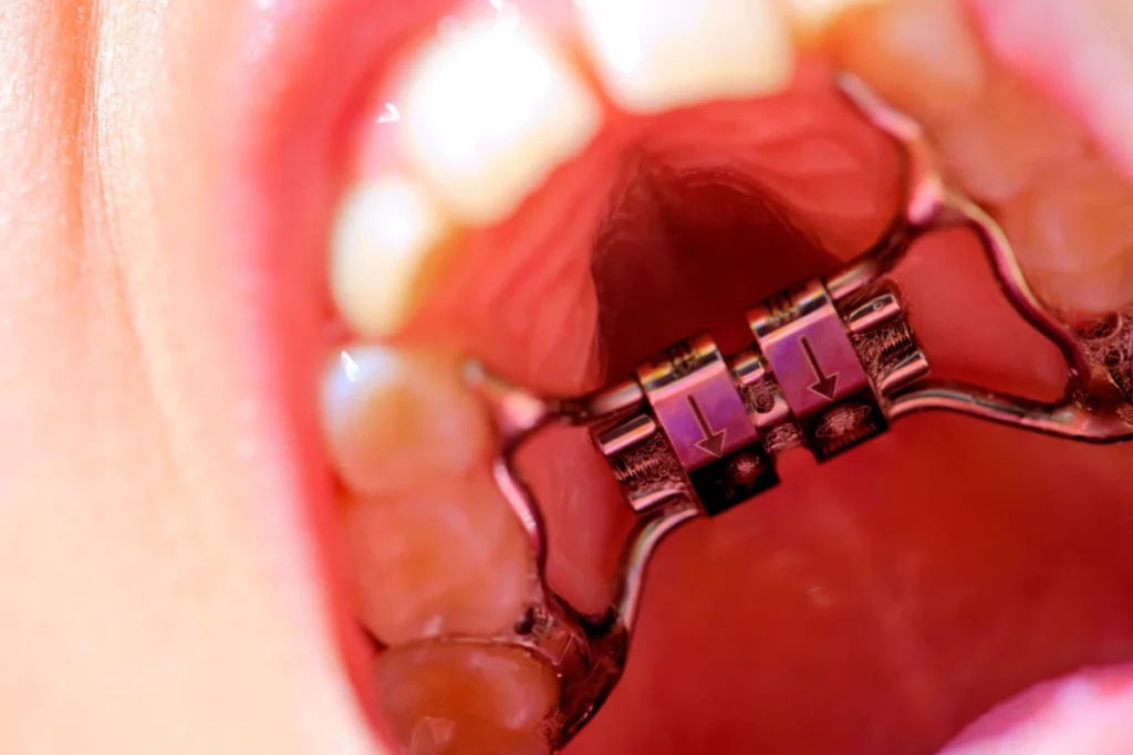 disjoncteur orthodontie enfant x disjoncteur orthodontie enfant x Orthodontie Cabinet
