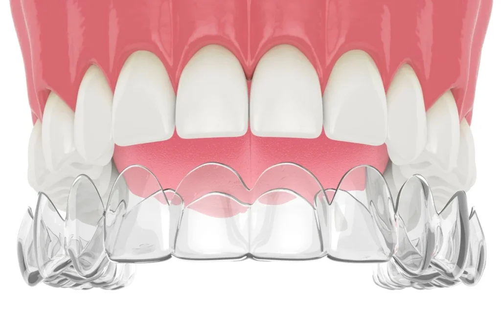 orthodontie aligneur invisible contention edited x orthodontie aligneur invisible contention edited x Orthodontie Cabinet